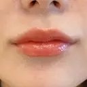 スマイルリフト(口角挙上)の症例写真です♪自然に口角アップが叶います！【口角挙上(スマイルリフト)】 before画像 サムネイル用