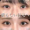【💖涙袋ヒアルロン酸💖】 after画像 サムネイル用