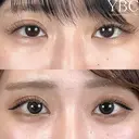 【💖涙袋ヒアルロン酸💖】 before画像 サムネイル用