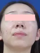 鼻尖縮小+鼻翼縮小(外側) before画像 サムネイル用