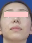 鼻尖縮小+鼻翼縮小(外側) 90日後 サムネイル用