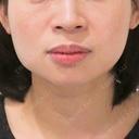ボトックス注射でエラを解消して小顔に♪エラへのボトックス注射、処置前と処置後1ヶ月の症例です！【小顔エラボトックス注射】 before画像 サムネイル用