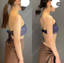 ベイザー脂肪吸引二の腕+肩 after画像 サムネイル用