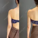 ベイザー脂肪吸引二の腕全周 after画像 サムネイル用