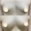 アキーセル併用コンデンスリッチ脂肪豊胸＋BANNAI式オリジナル３D注入法＋シリンジ法＋Zプラス before画像 サムネイル用