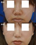 鼻尖縮小+鼻翼縮小（外側） after画像 サムネイル用