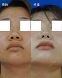 鼻尖縮小+鼻翼縮小（外側） after画像 サムネイル用