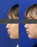 鼻尖縮小＋鼻尖部耳介軟骨移植 after画像 サムネイル用