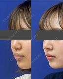 鼻尖縮小＋鼻尖部耳介軟骨移植 after画像 サムネイル用