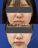 鼻尖縮小＋鼻尖部耳介軟骨移植 after画像 サムネイル用