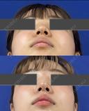 鼻尖縮小＋鼻尖部耳介軟骨移植 after画像 サムネイル用
