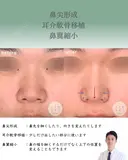 鼻尖形成＋耳介軟骨移植＋鼻翼縮小 after画像 サムネイル用