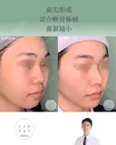 鼻尖形成＋耳介軟骨移植＋鼻翼縮小 after画像 サムネイル用