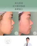 鼻尖形成＋耳介軟骨移植＋鼻翼縮小 after画像 サムネイル用