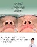 鼻尖形成＋耳介軟骨移植＋鼻翼縮小 after画像 サムネイル用