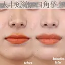 人中短縮＋口角挙上 before画像 サムネイル用