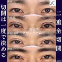 二重全切開✨ before画像 サムネイル用