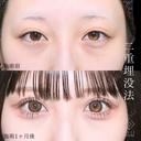 選べるオーダメイド二重埋没法 after画像 サムネイル用