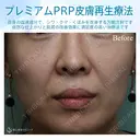 【女性・ほうれい線、たるみ改善後２年経過】プレミアムPRP皮膚再生療法（２年後） before画像 サムネイル用