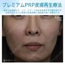 【女性・ほうれい線、たるみ改善後２年経過】プレミアムPRP皮膚再生療法（２年後） after画像 サムネイル用