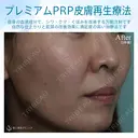 【女性・ほうれい線、たるみ改善後２年経過】プレミアムPRP皮膚再生療法（２年後） after画像 サムネイル用