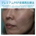 【女性・ほうれい線、たるみ改善後２年経過】プレミアムPRP皮膚再生療法（２年後） after画像 サムネイル用