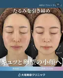 ハイフ　ウルトラセルzi before画像 サムネイル用