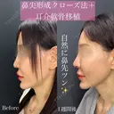 鼻尖形成（クローズ法）＋耳介軟骨移植 before画像 サムネイル用