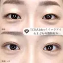 二重埋没・まぶたの脂肪取り before画像 サムネイル用
