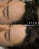 ヘアラインアートメイク before画像 サムネイル用