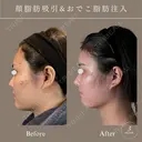 顔脂肪吸引、脂肪注入 before画像 サムネイル用