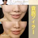 貴族フィラー after画像 サムネイル用