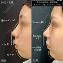 鼻尖形成3D法、軟骨移植、あごヒアルロン酸、あごボツリヌス注射 30日後 サムネイル用