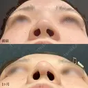 鼻尖形成3D法、軟骨移植、あごヒアルロン酸、あごボツリヌス注射 30日後 サムネイル用