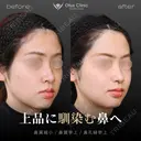 小鼻縮小・鼻翼挙上・鼻孔縁挙上 before画像 サムネイル用