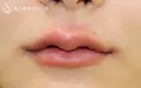 【20代女性・スマイルリップ】ヒアルロン酸＆スマイルボトックス（注入直後） after画像 サムネイル用