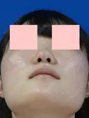 鼻尖縮小 before画像 サムネイル用