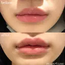 スマイルリップ(唇ヒアルロン酸+口角ボトックス) after画像 サムネイル用