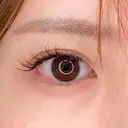 腫れと痛みも最小限のタレ目形成術♪パーフェクトアイズの処置前と処置直後の症例です【たれ目形成術クイック法/目尻切開法】 before画像 サムネイル用