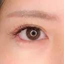 腫れと痛みも最小限のタレ目形成術♪パーフェクトアイズの処置前と処置直後の症例です【たれ目形成術クイック法/目尻切開法】 0日後 サムネイル用