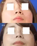 鼻尖縮小＋鼻翼縮小（外側） after画像 サムネイル用
