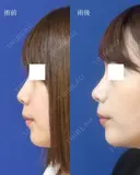 鼻尖縮小＋鼻翼縮小（外側） after画像 サムネイル用