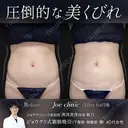 脂肪吸引（腹部） before画像 サムネイル用