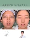 鼻中隔延長で口元をきれいにする before画像 サムネイル用