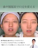 鼻中隔延長で口元をきれいにする after画像 サムネイル用