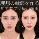 糸リフト＋脂肪吸引 30日後 サムネイル用