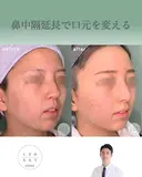 鼻中隔延長で口元をきれいにする after画像 サムネイル用