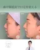 鼻中隔延長で口元をきれいにする after画像 サムネイル用