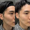 サブシジョンやり放題 × ジュベルック ドクター手打ち全顔（1回） after画像 サムネイル用