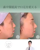 鼻中隔延長で口元をきれいにする after画像 サムネイル用